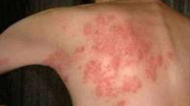 Cara Mengobati Penyakit Herpes
