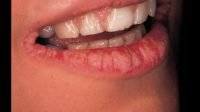 Candidiasis Oral