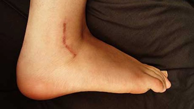 Cara Menghilangkan Bekas Luka Yang Menonjol