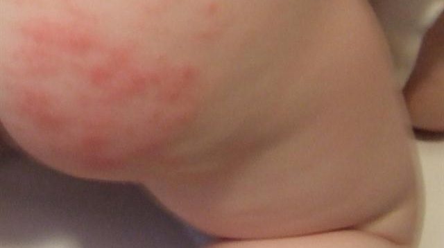 Cara Mengobati Ruam Popok Pada Bayi (Diaper Rash)