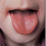 Defisiensi Zink Pada Bayi