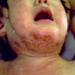 Intertrigo Pada Bayi