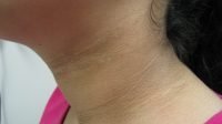 Cara Mengobati Penyakit Acanthosis Nigricans