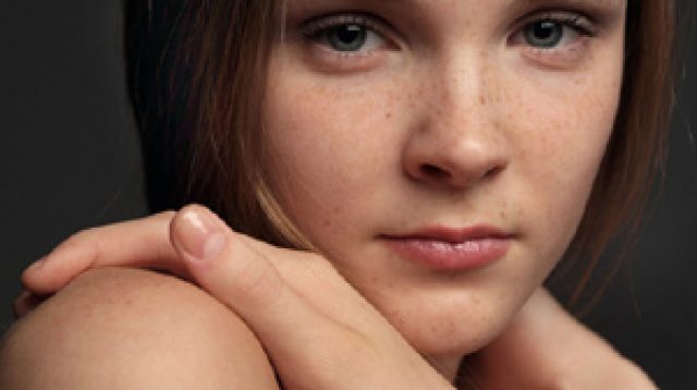 Melasma