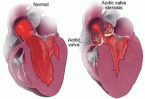 Penyakit Jantung Stenosis Mitral