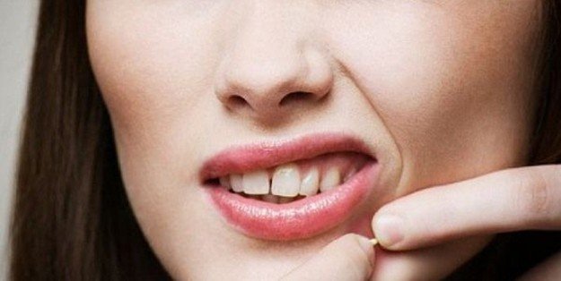 Ketahui Jenis Jerawat Yang Menyerang Anda