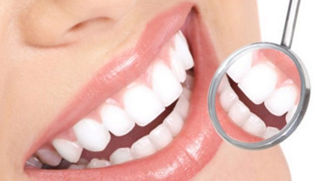 Pantangan Pasca Veneer Gigi
