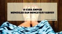 10 Cara Ampuh Mencegah dan Mengatasi Varises