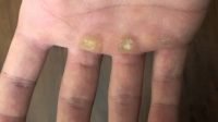 Cara Menghilangkan Kapalan di Tangan
