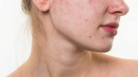 ob_4cadc2_acne-rosacea
